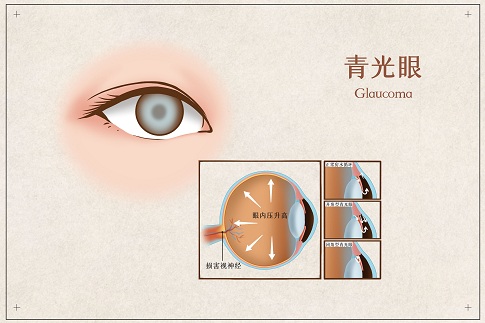 1659973542831971.jpg 攝圖網(wǎng)_401804072_青光眼醫(yī)療插畫(企業(yè)商用).jpg